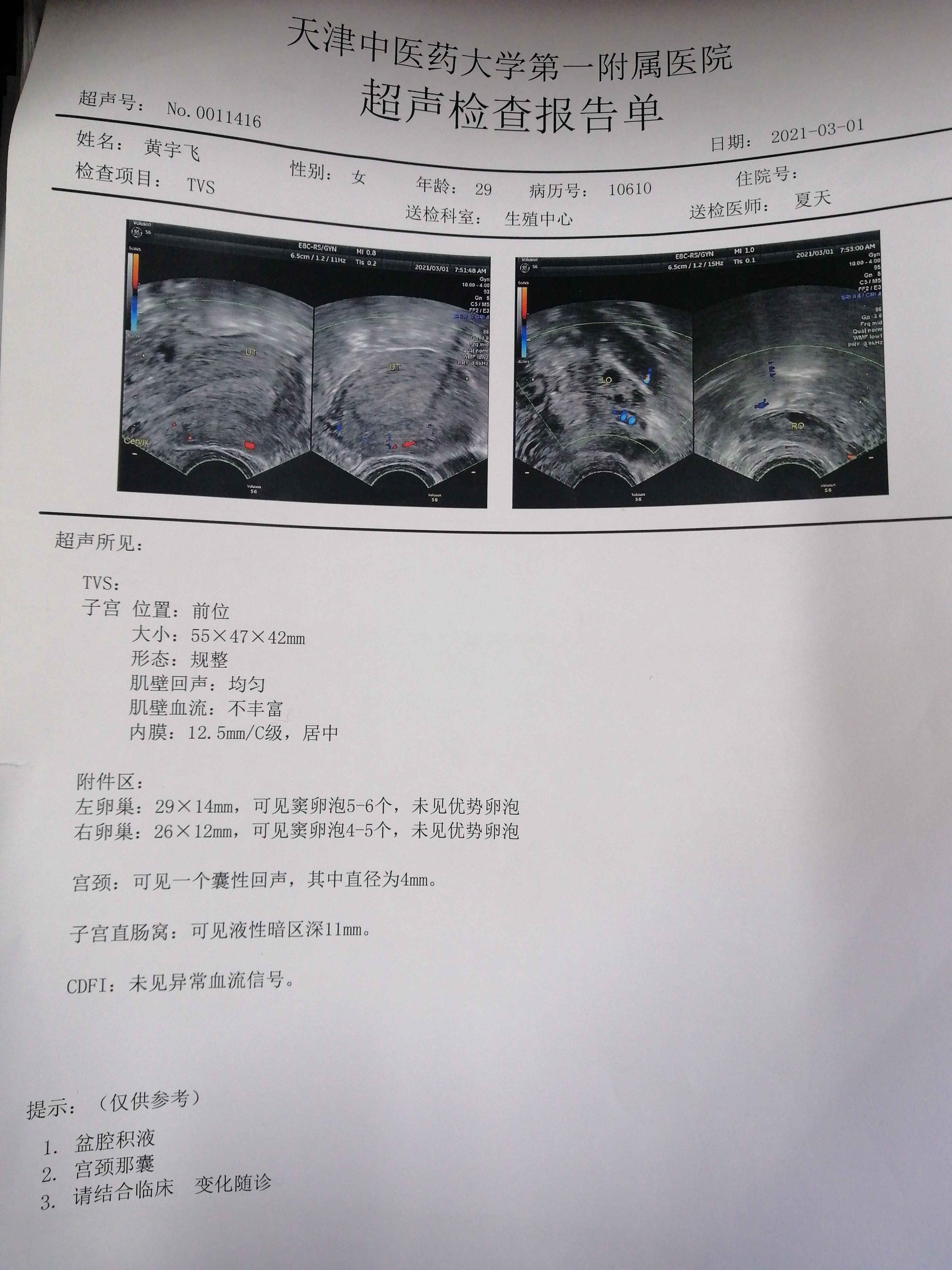 卵泡监测结果解读218月经目前第12天卵泡监