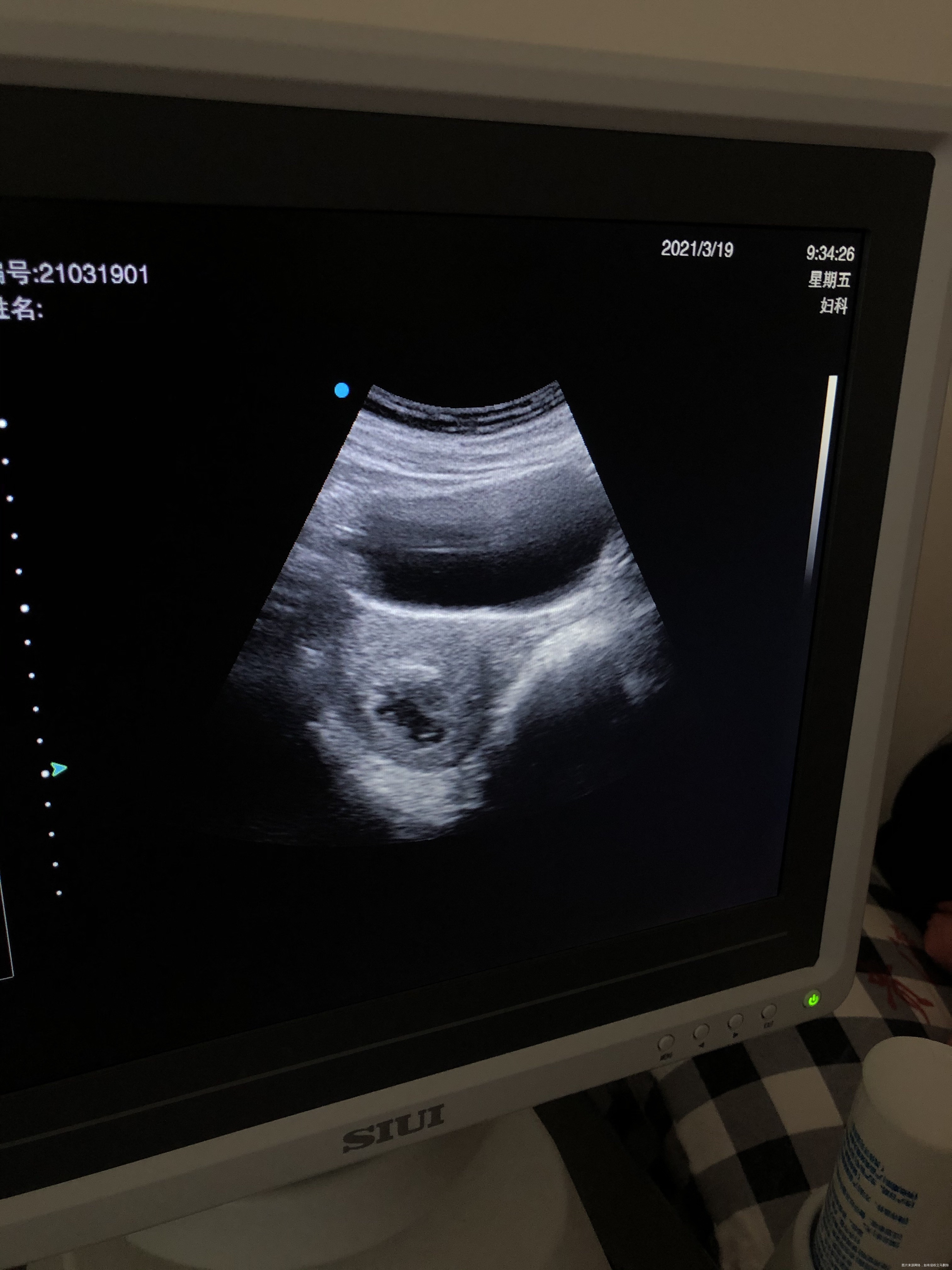 胎停3次这次又停了月初刮宫现在还没干净