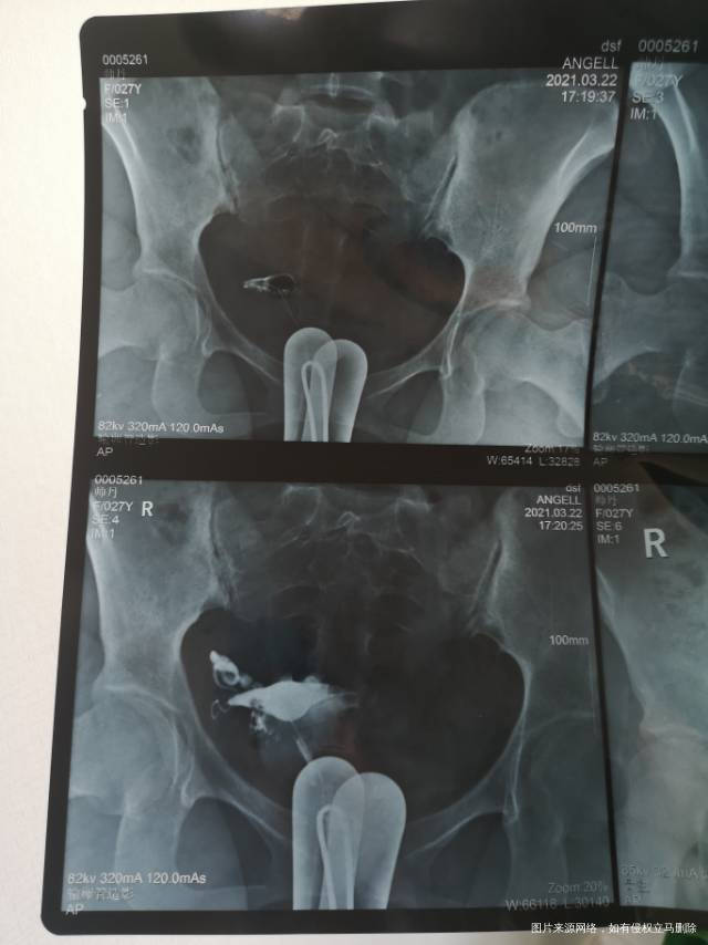 这是这个月做的检查有得医生建议做宫腹腔镜联合