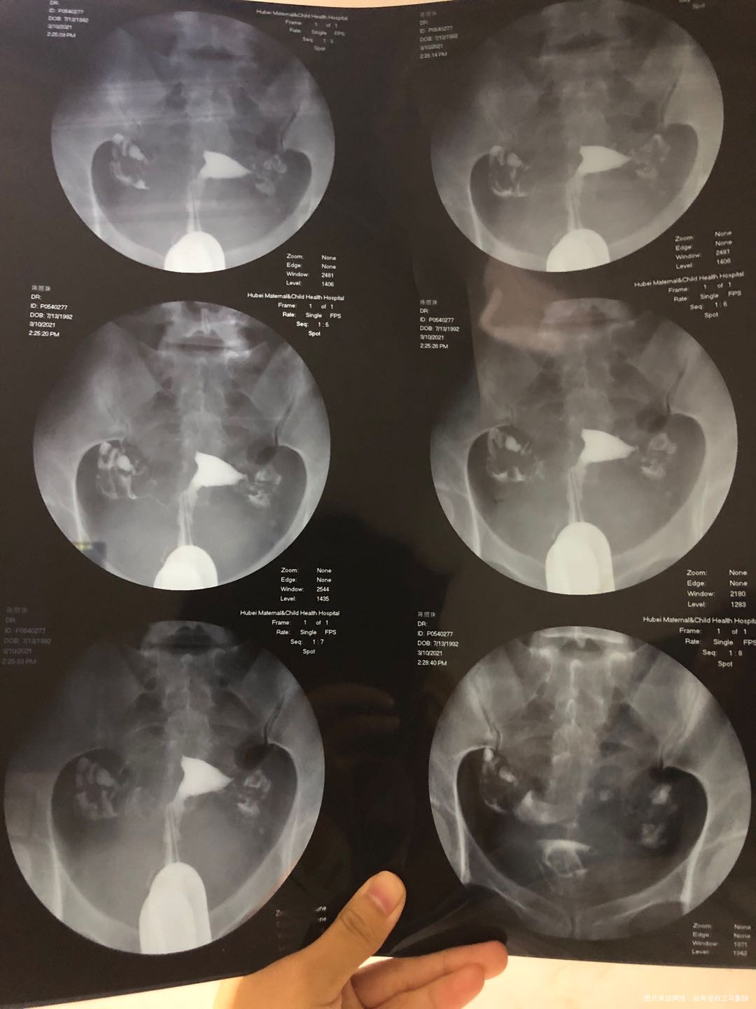 一子十岁隔年人流一次19年宫外孕保守治疗右侧