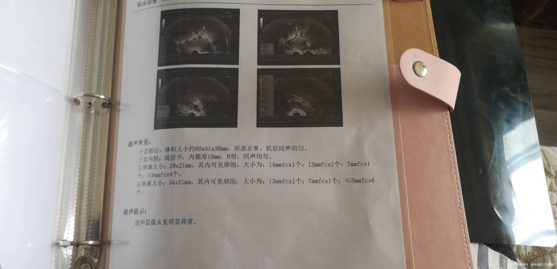 这是这个月做的检查有得医生建议做宫腹腔镜联合