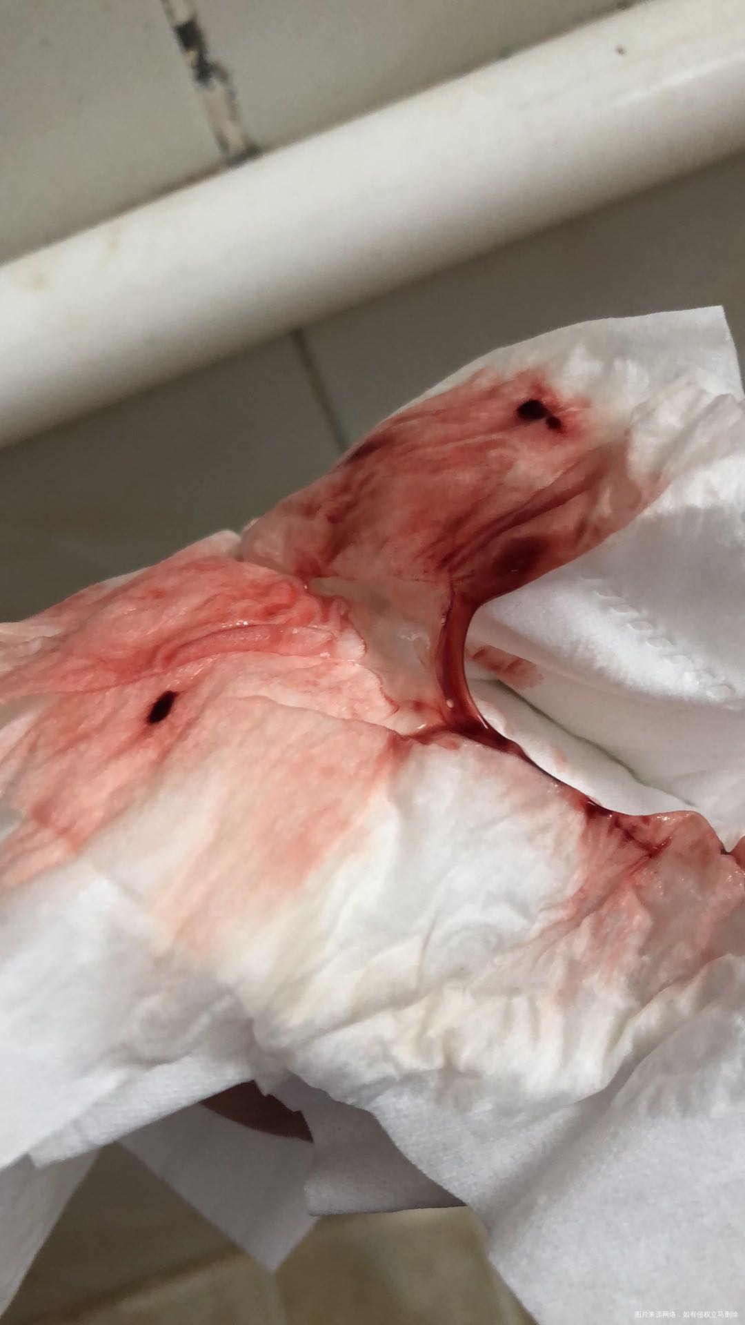 现在出那种白带带血丝那种白带跟清鼻涕一样带血