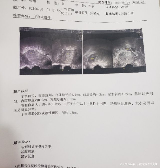 卵巢一侧多囊是否可以自然受孕