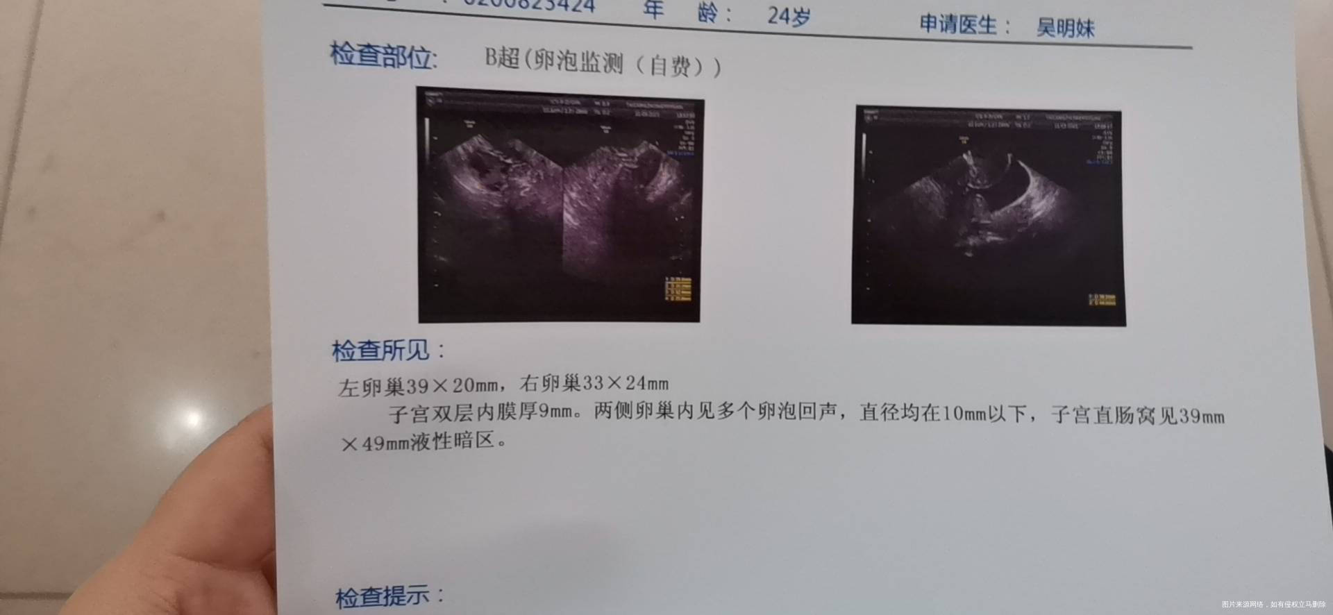 月经第15天打了绒促今天第18天监测排卵医生