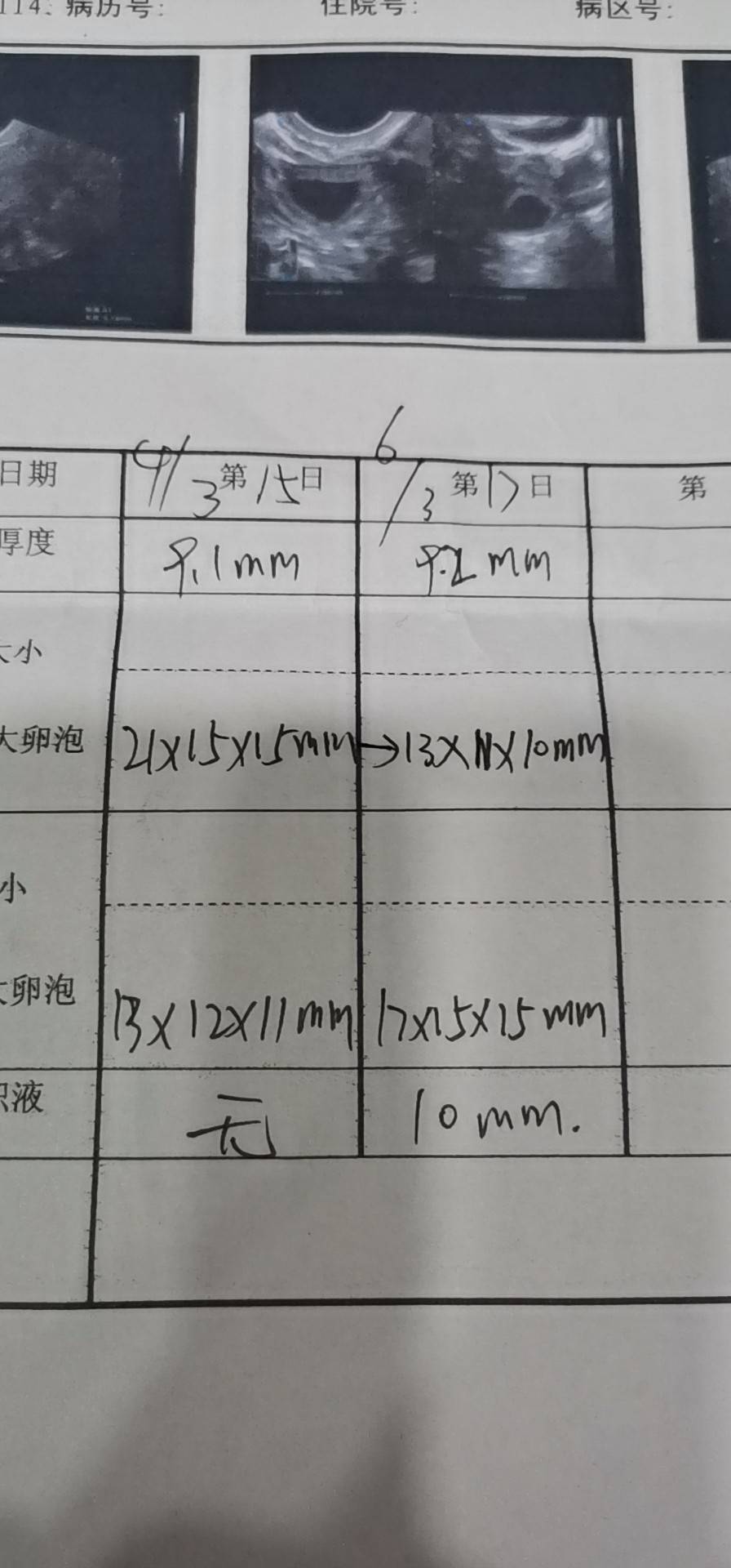 月经第15天第17天对比右边已排