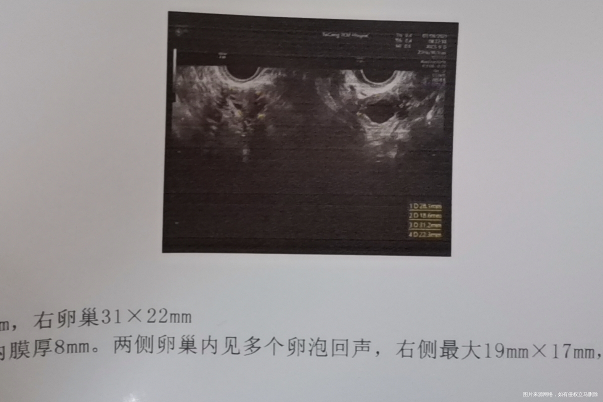 月经第15天打了绒促今天第18天监测排卵医生