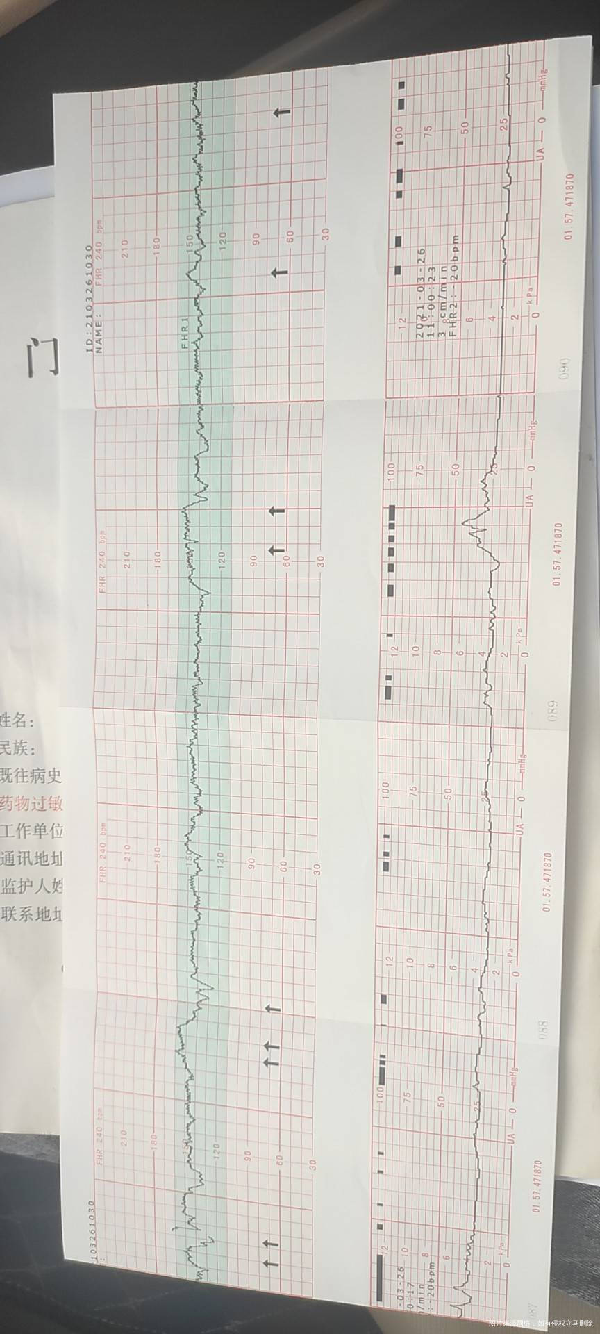 请各位医生帮忙看下我这个b超单和胎心监护正常