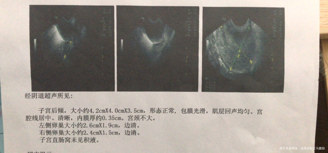 3月26日拍的阴超医生开了四天尿促今天28号