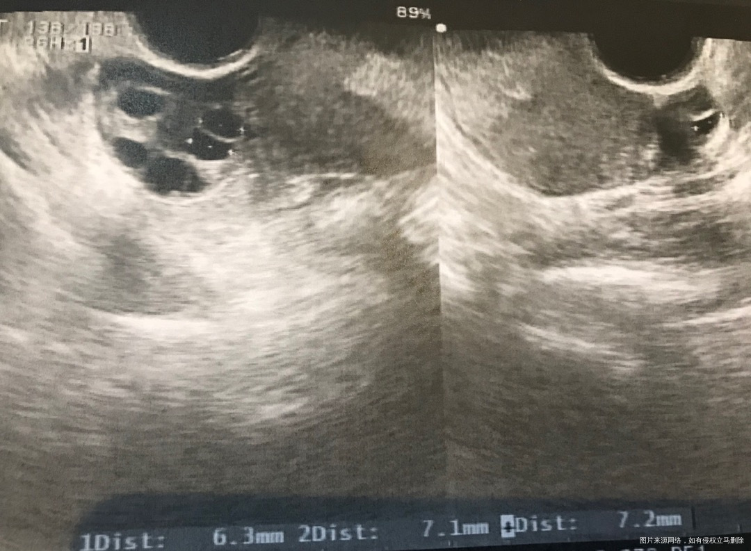 月经第四天查窦卵泡数请看看图是否正常左侧只有