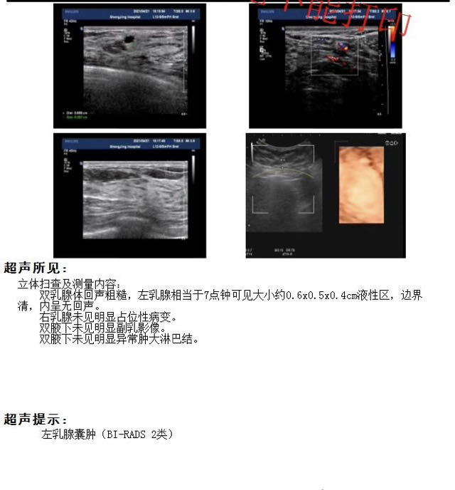 您好医生19年右侧输卵管宫外孕过保守治疗后面