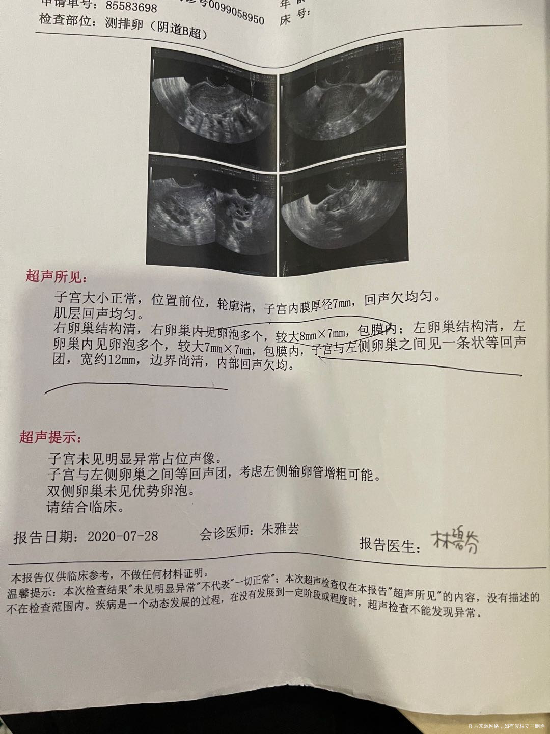 多囊卵巢综合症的患者想要生小孩是不是必须要促