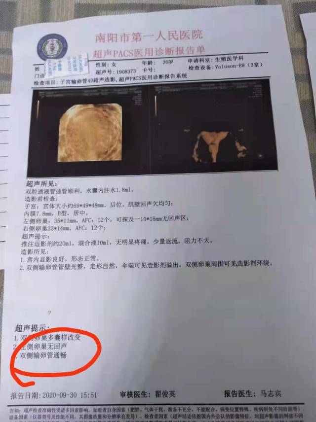 多囊每月来月经排卵障碍左侧输卵管不通没有流产