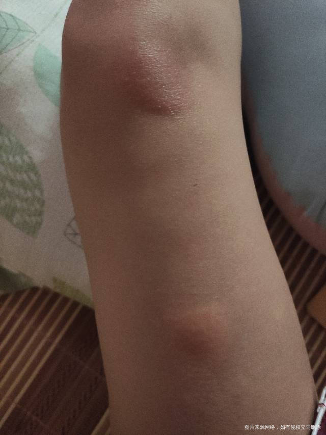 这两天右脚不知道被东西咬了还是怎么回事长这个