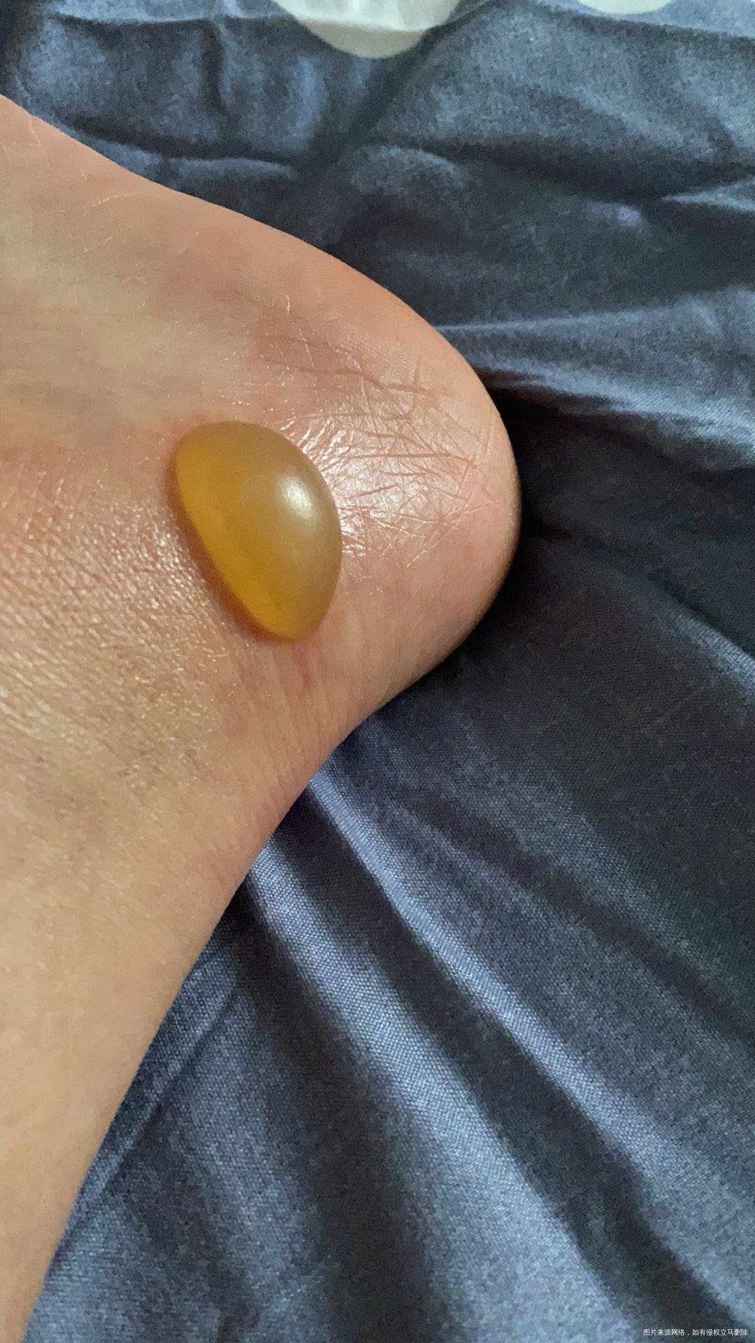 昨天被开水烫伤了然后昨天不停的走路现在水泡已