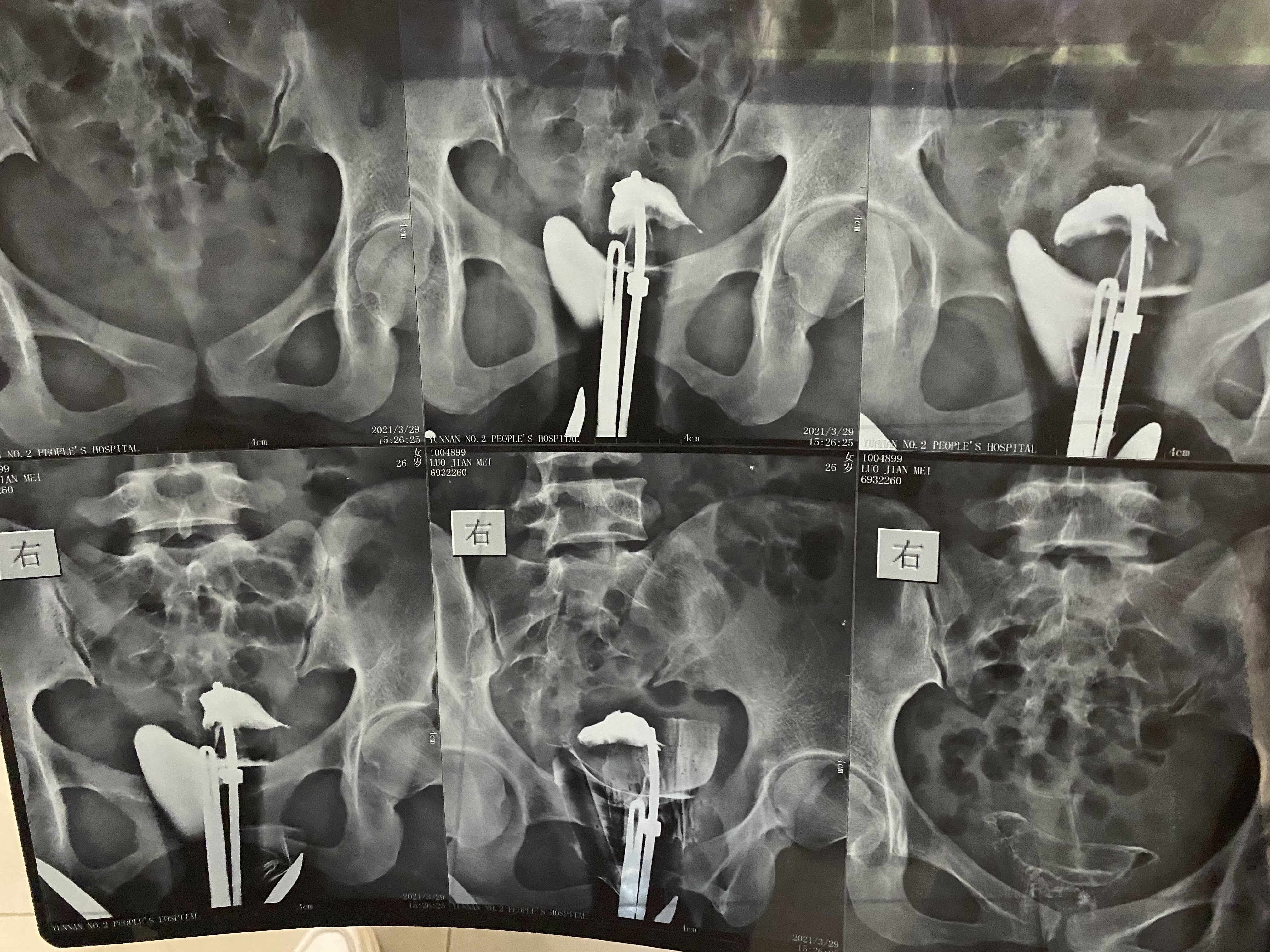 备孕多年未怀孕原发不孕本月做输卵管造影报告显