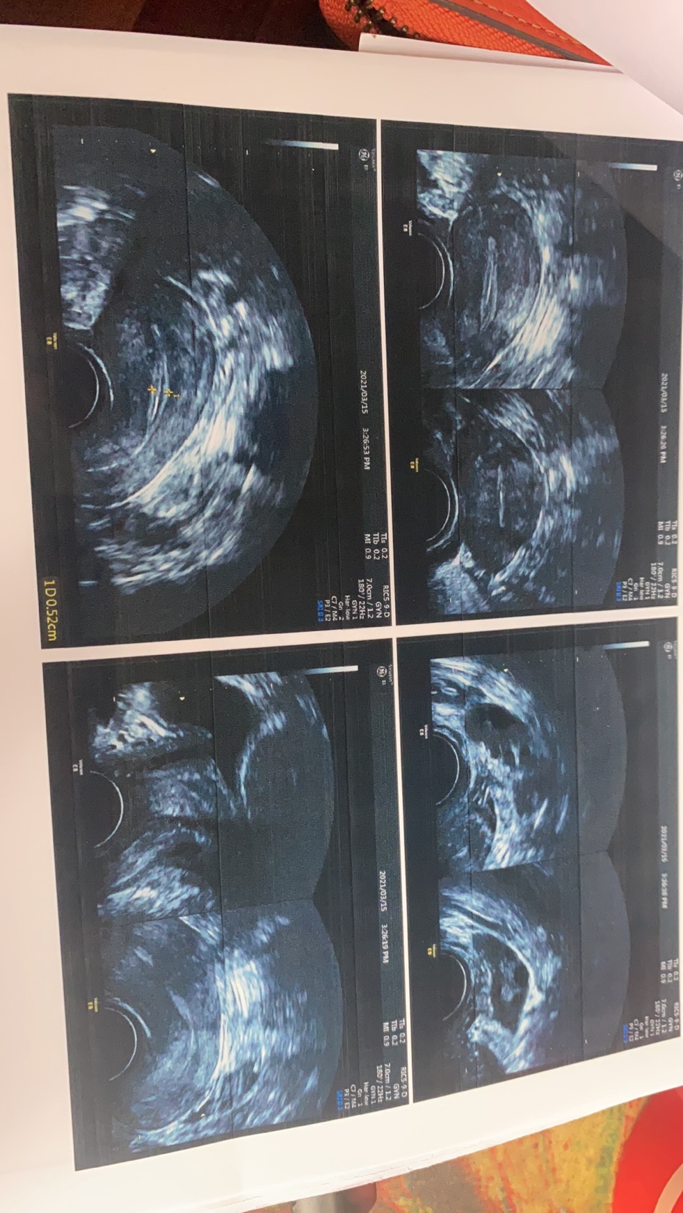 医生您好麻烦您帮我看一下我做的三维彩超报告是