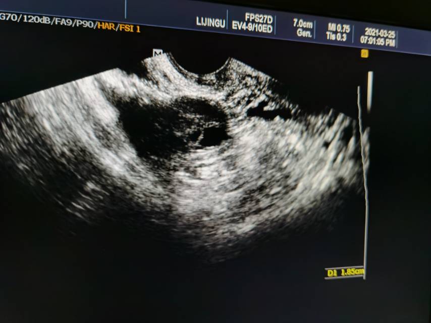 之前做过的性激素六项检查睾酮有点高身体多毛超