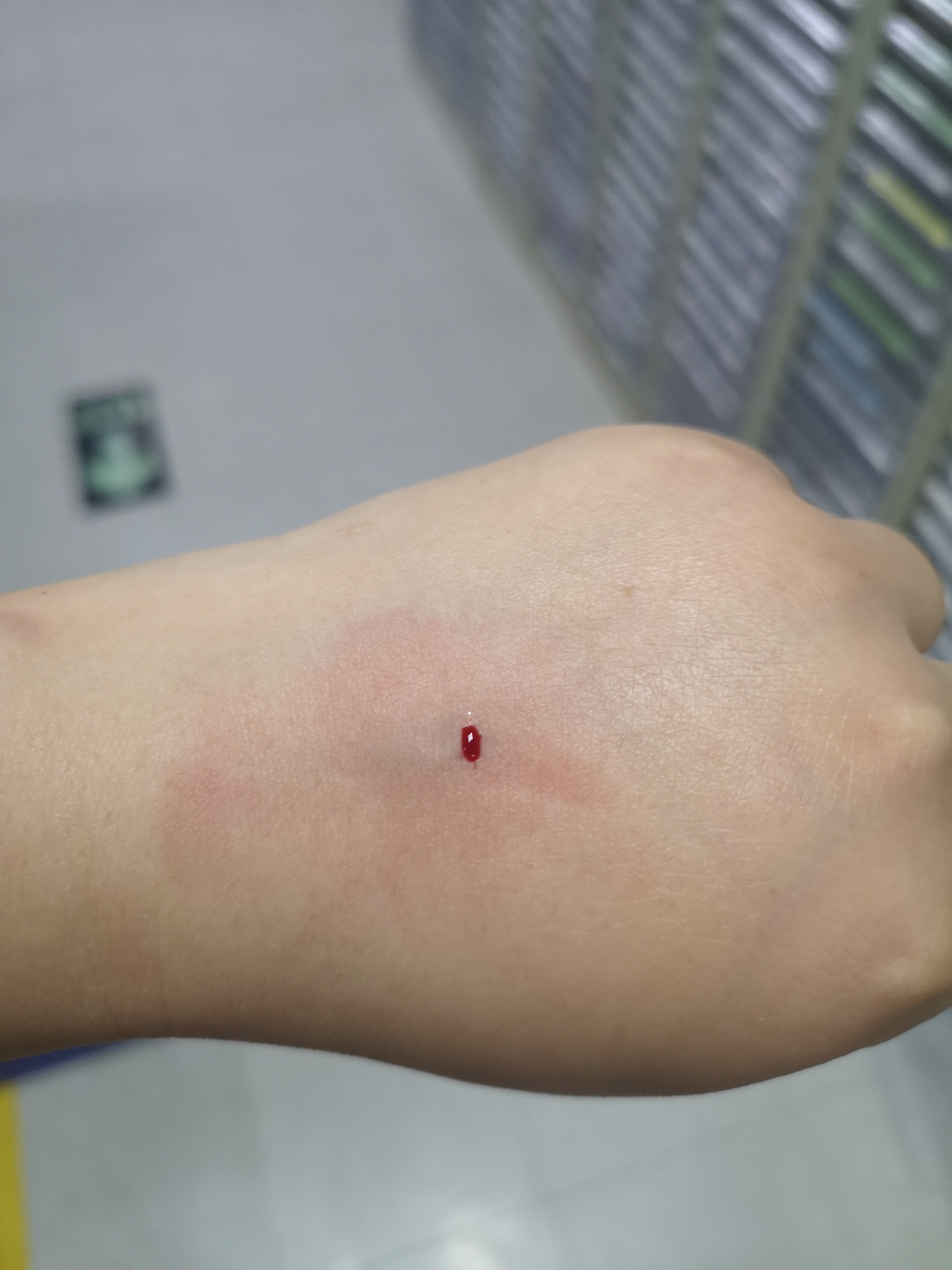 今天公司体检手臂扎针不出血还被用针头在里面搅