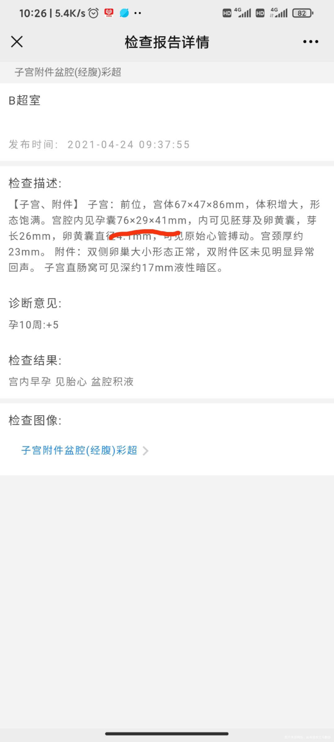 孕10周+2之前孕酮低一直在吃药这几天吃药吃