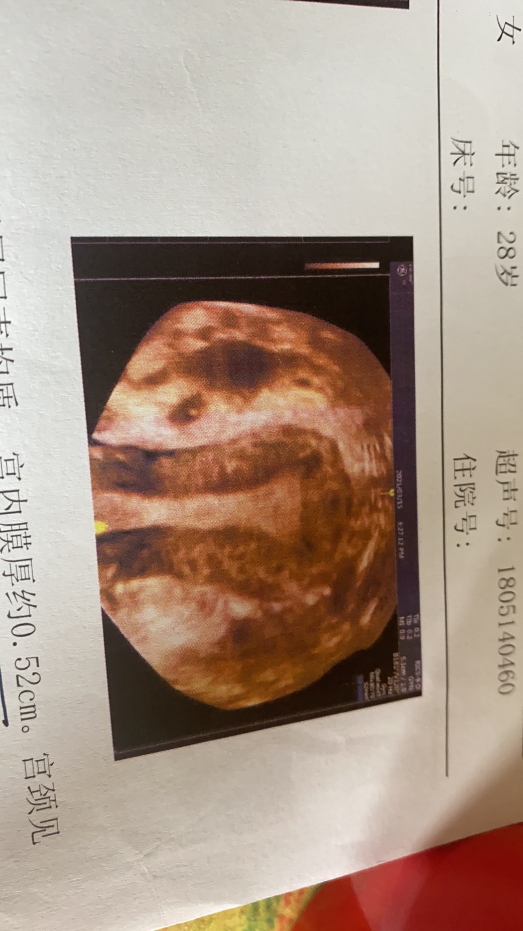 医生您好麻烦您帮我看一下我做的三维彩超报告是