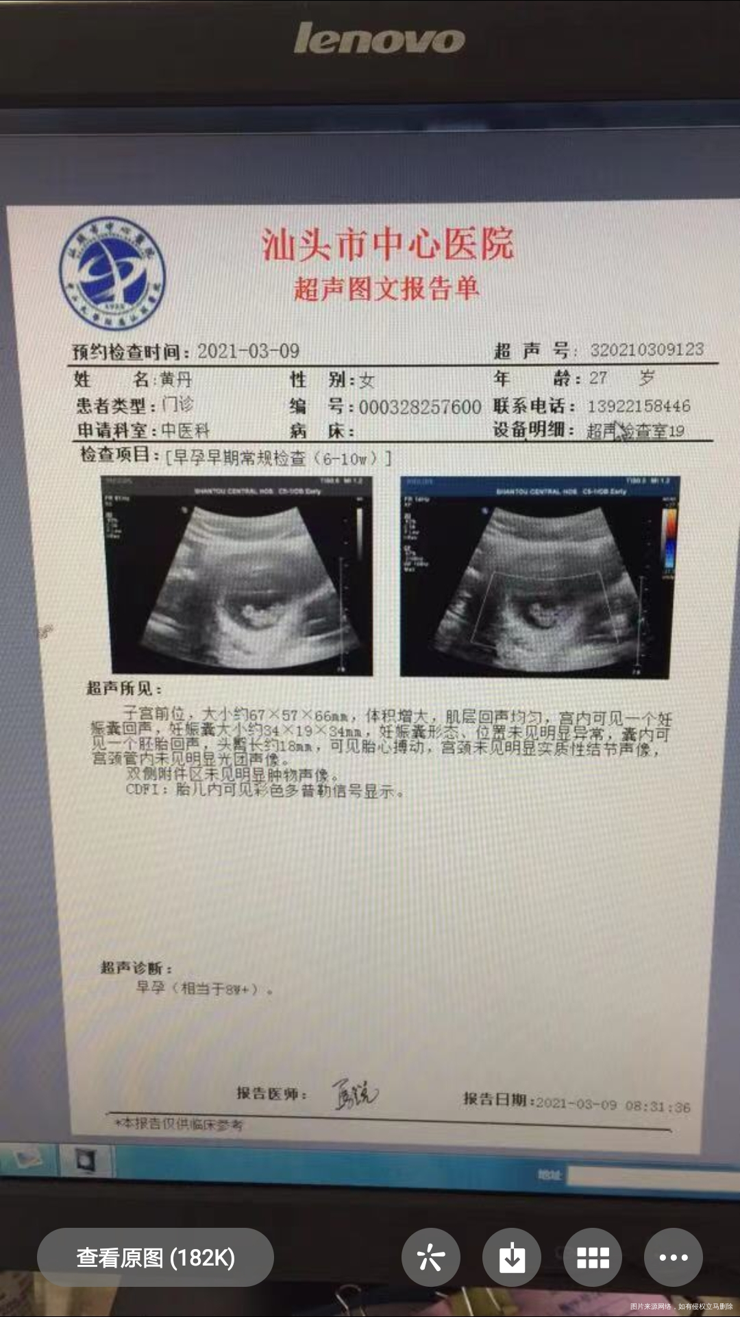 末次月经是202115孕6周时查出胎心胎芽h