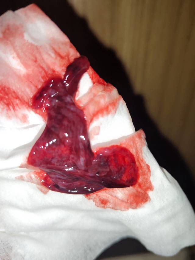 大夫您好我想一咨询一下本月备孕打了15只人体