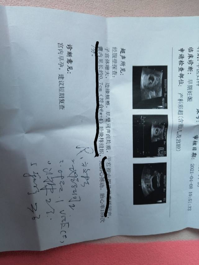 医生这是我怀孕52天做的B超胎块是什么意思自