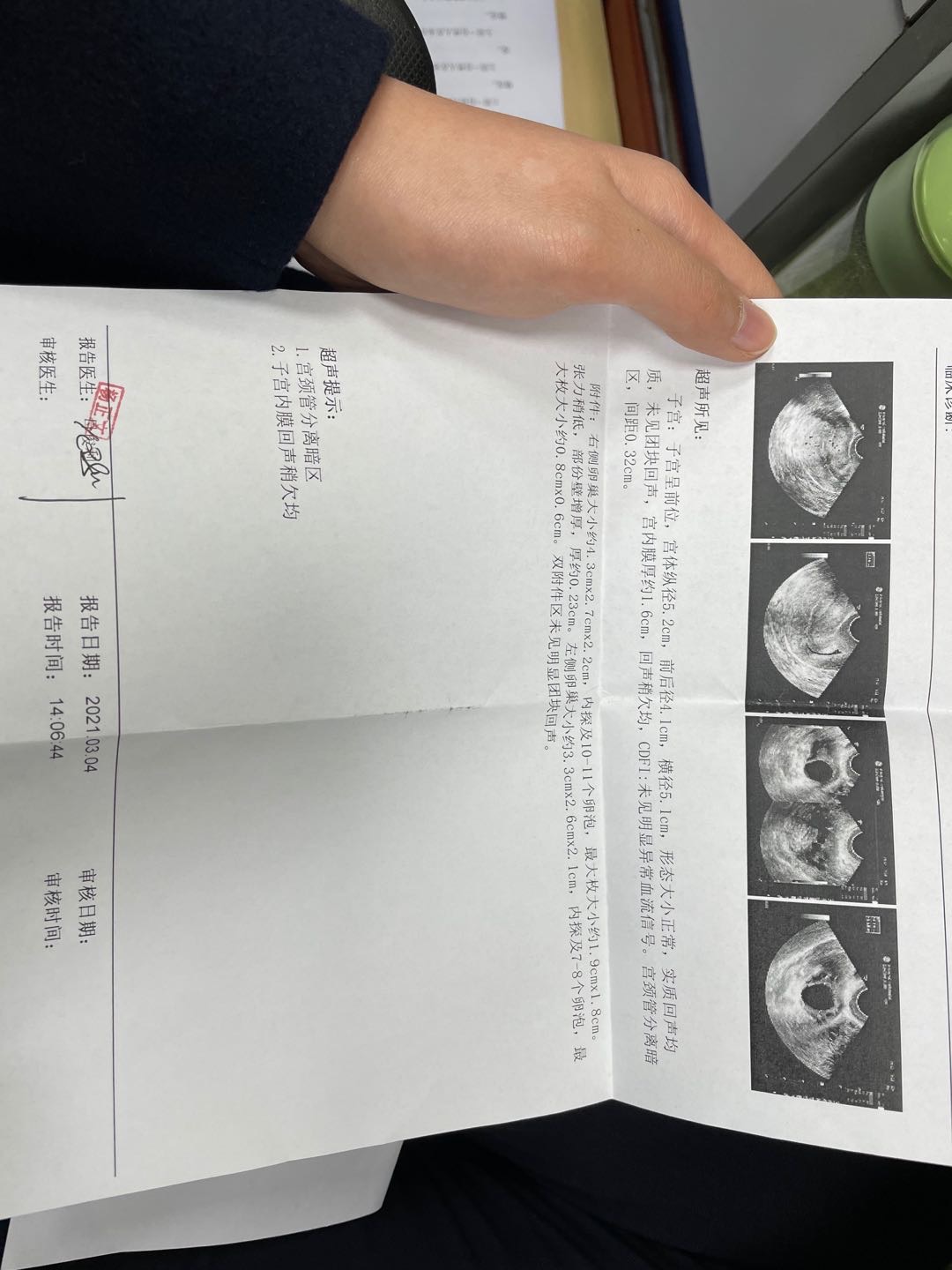 2017年至今发生5次生化妊娠目前备孕中排卵