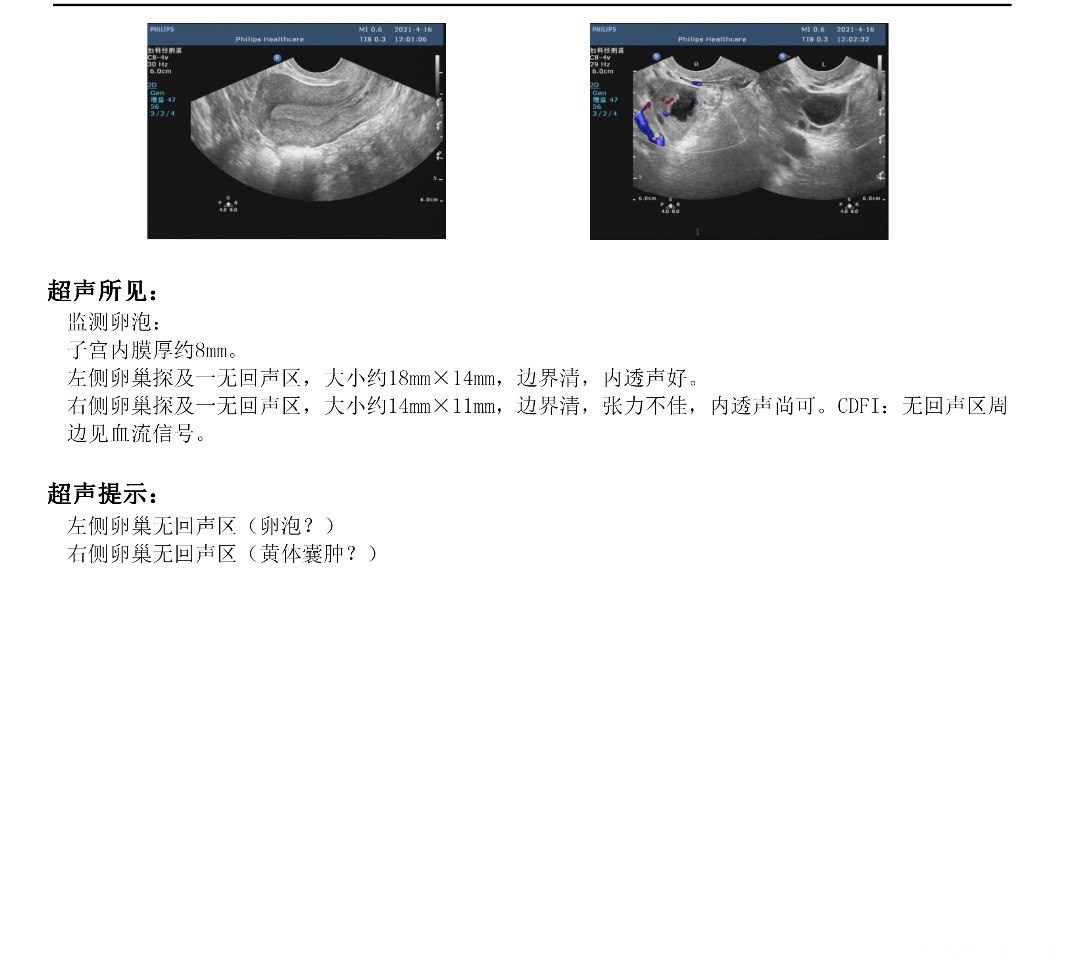 打了破卵针过了两天来查这是排了吗