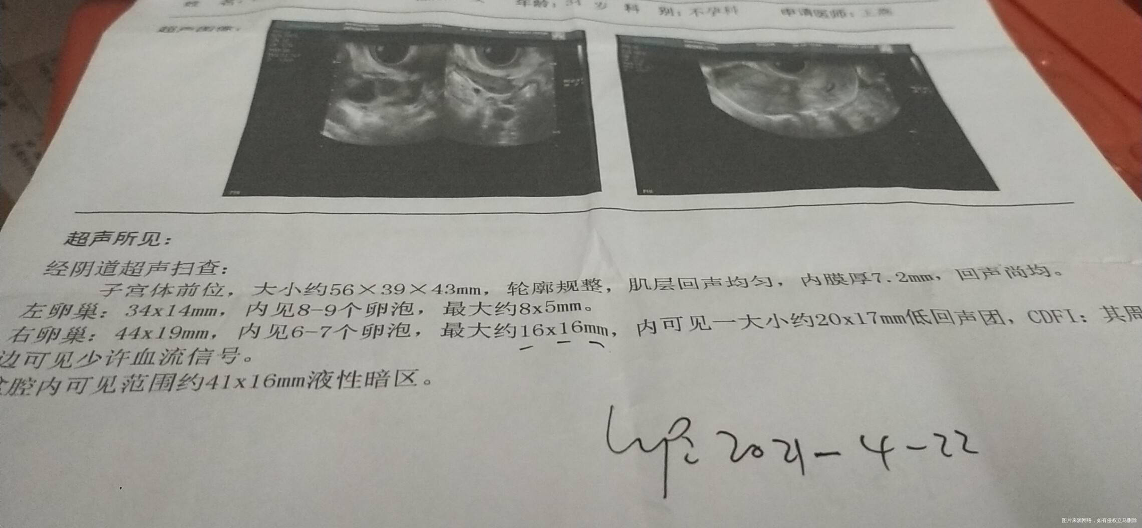 月经周期第八天监测卵泡和抽血