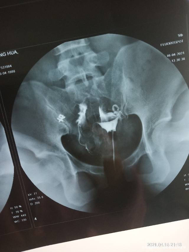 您好麻烦您帮我看看这个片子是什么问题感谢