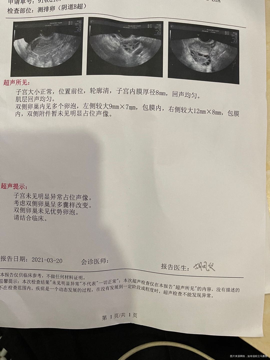 多囊卵巢综合症的患者想要生小孩是不是必须要促