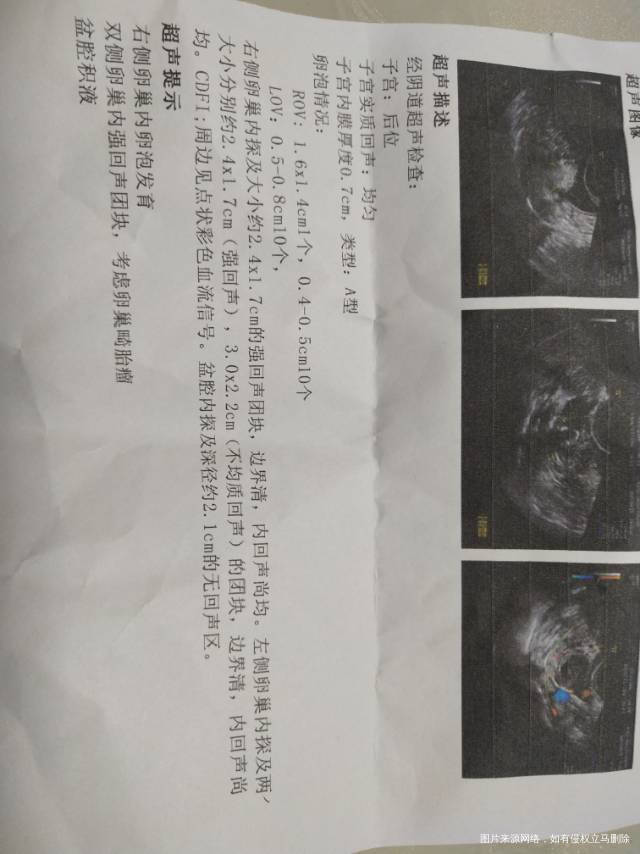 多囊卵巢促排的19年检查出左侧卵巢畸胎瘤12