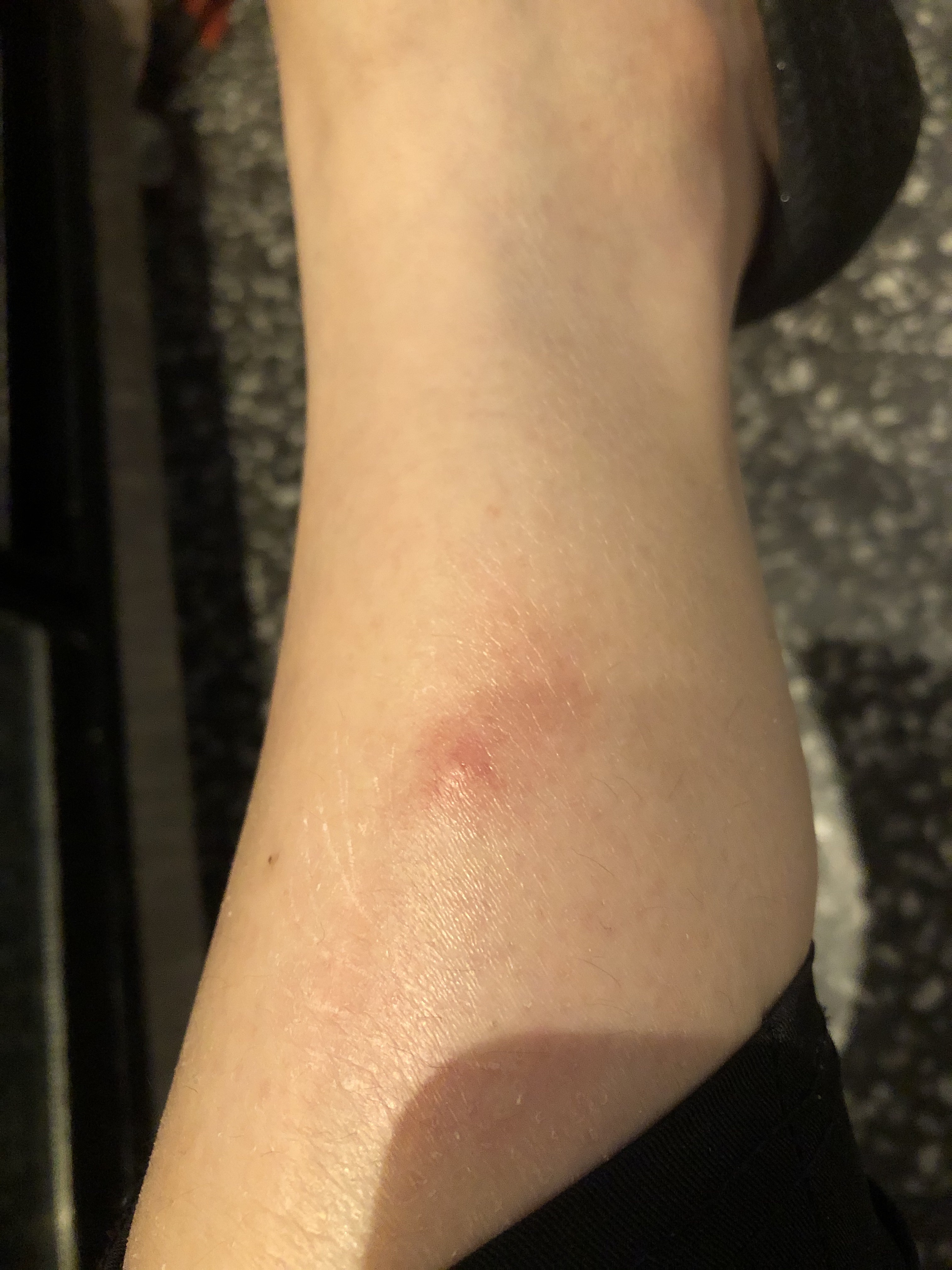 请问这些是什么也不是蚊子咬的每次早上睡醒起来