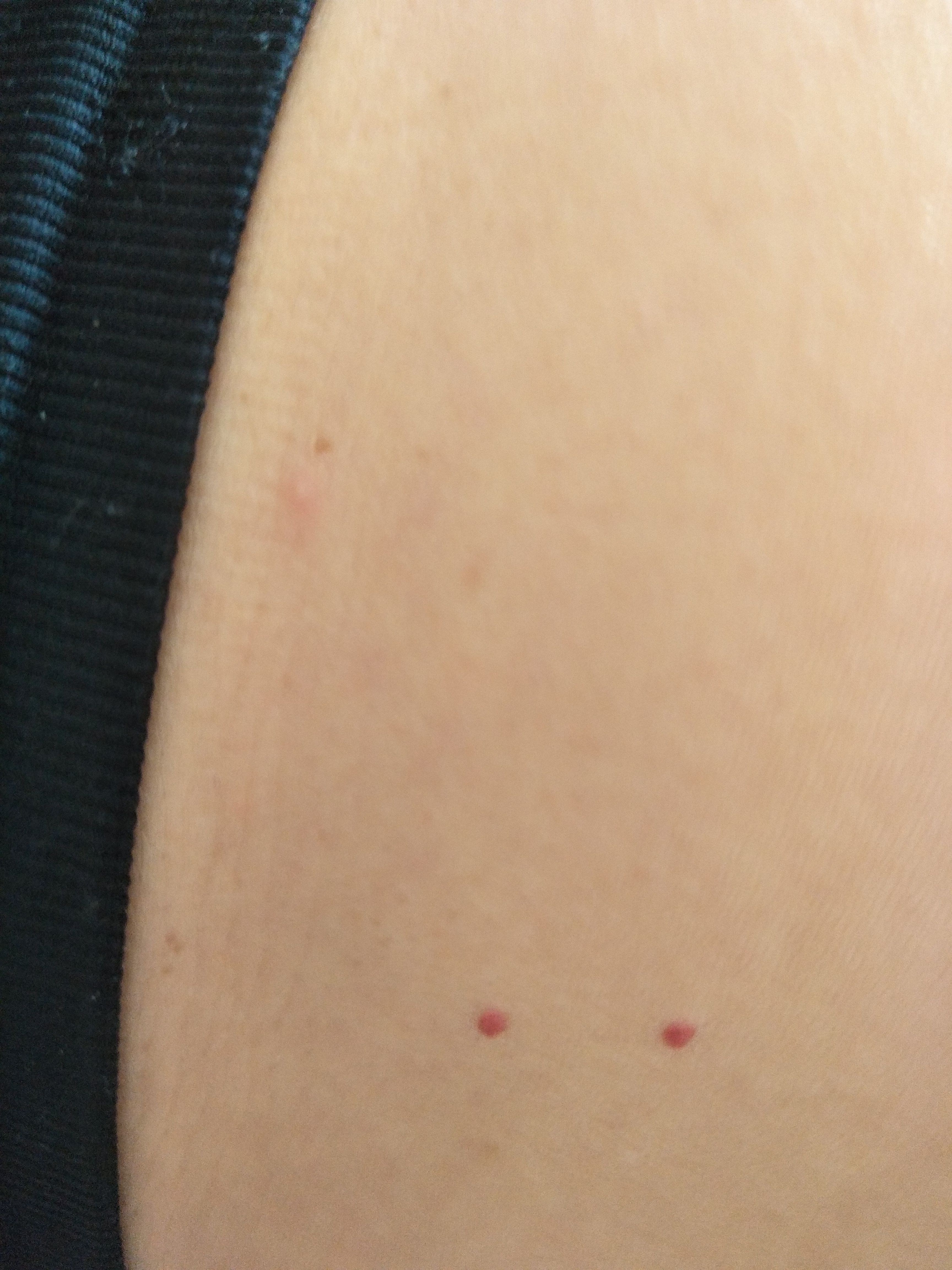 身上红点有好几年了之前也就一个最近发现上半身