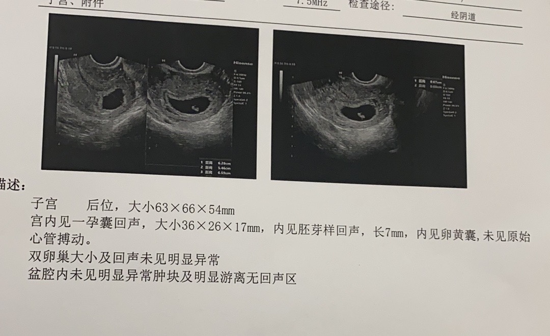 末次月经317今天去做b超医生说可能胎停请问