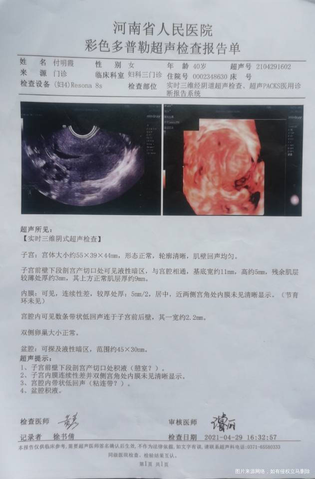 2020年5月诊所输卵管通水两次第一次左侧通