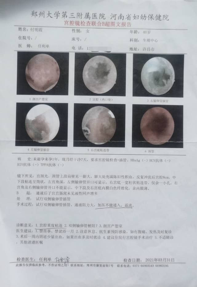 2020年5月诊所输卵管通水两次第一次左侧通