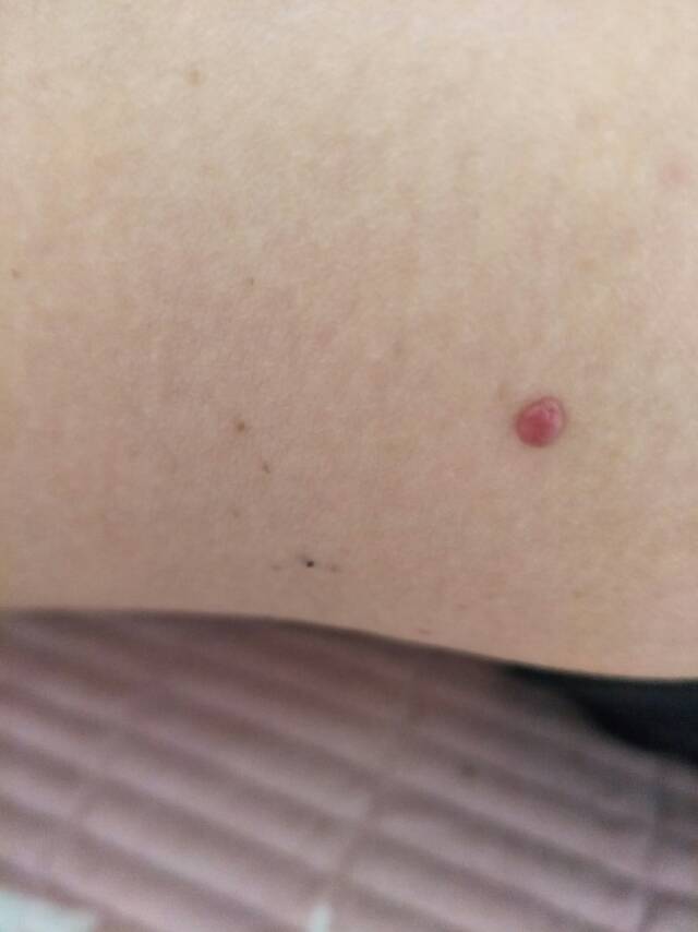 身上红点有好几年了之前也就一个最近发现上半身