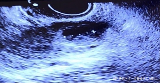 第一张图排卵前卵泡20毫米第二张图排卵后第六