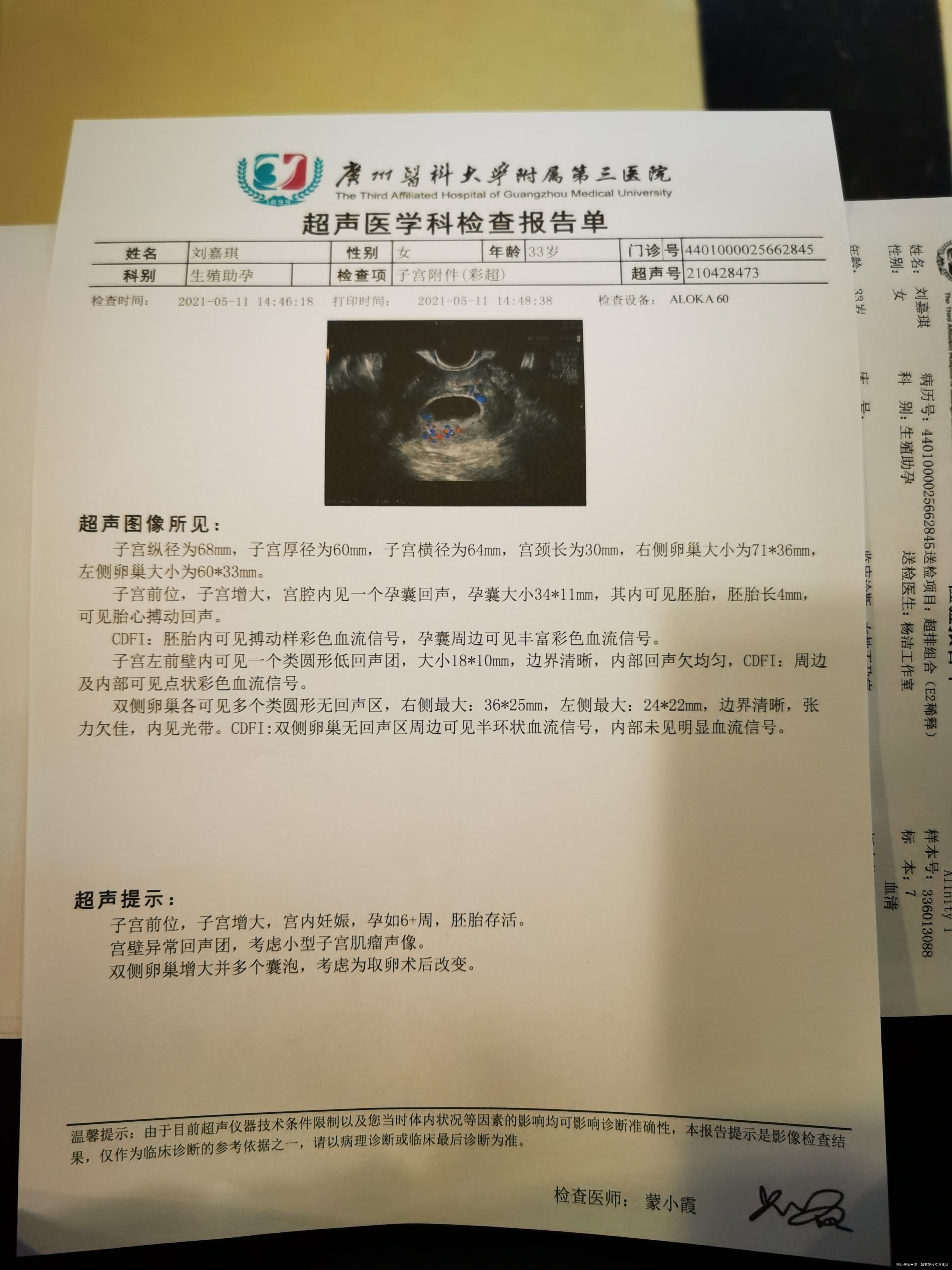 20210409取卵11颗5天后移植D5鲜胚