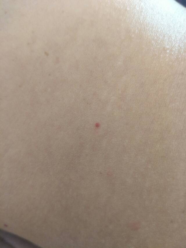 身上红点有好几年了之前也就一个最近发现上半身