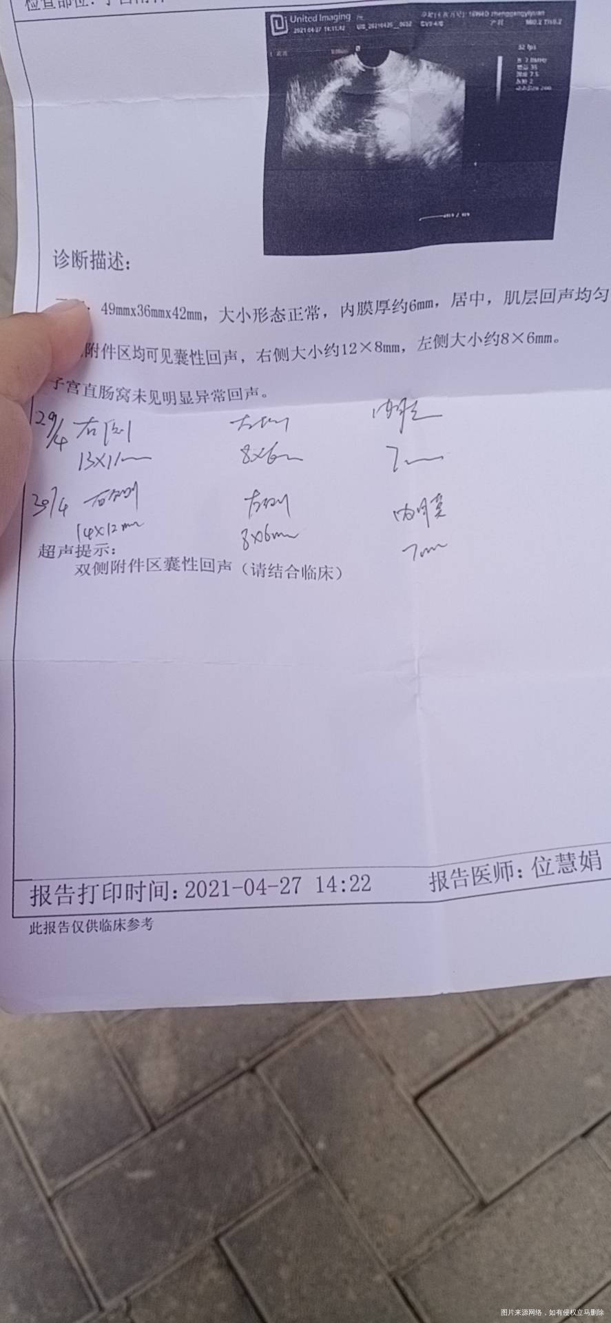 监测卵泡月经周期第11天12×8第13天13