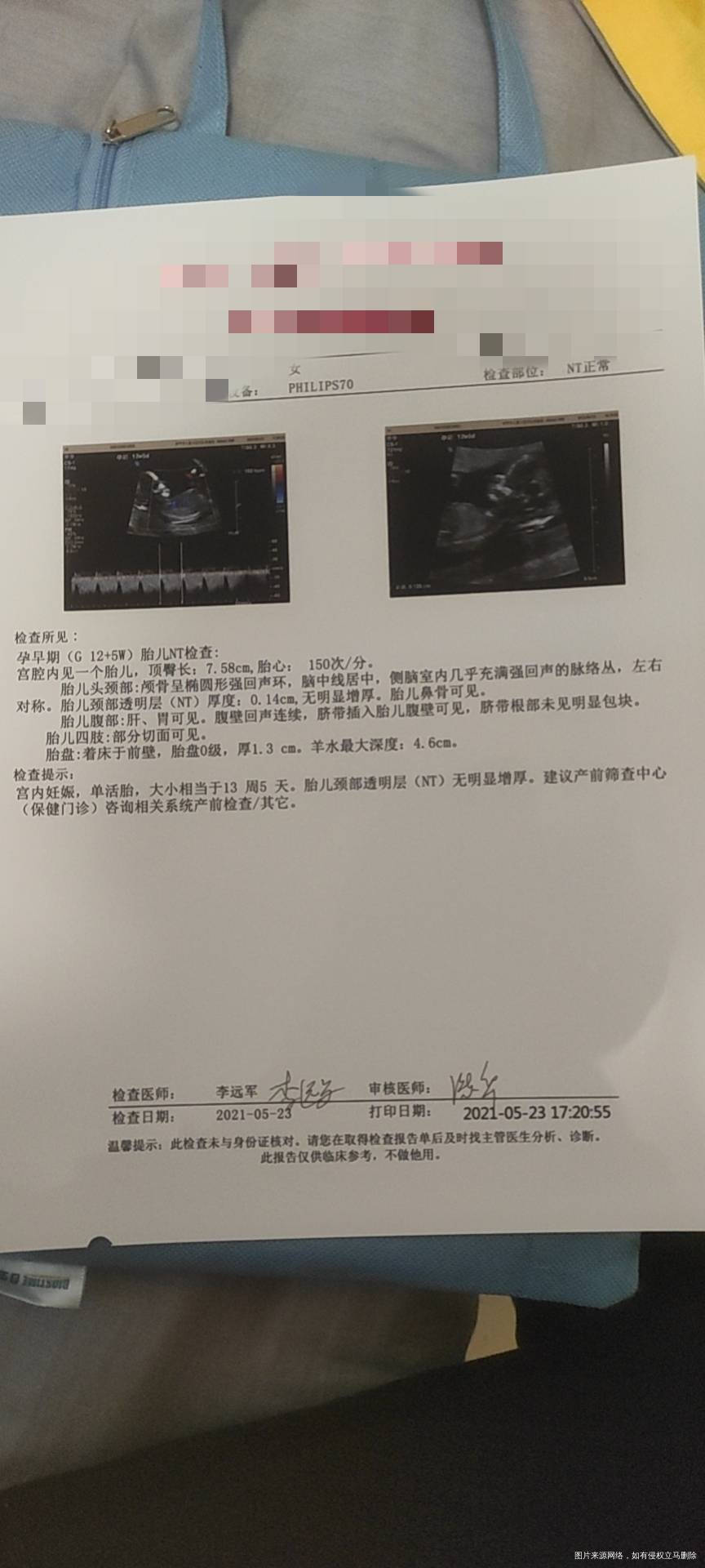 做了三次NT的结果第一二次医生都说位置不好看