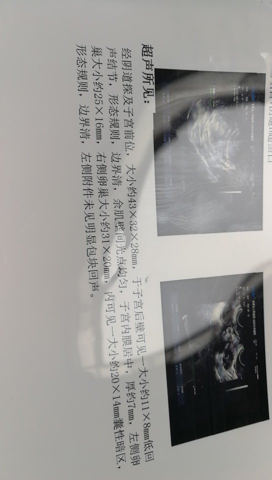 末次月经五月4日现在这个小肌瘤影响怀孕么上个