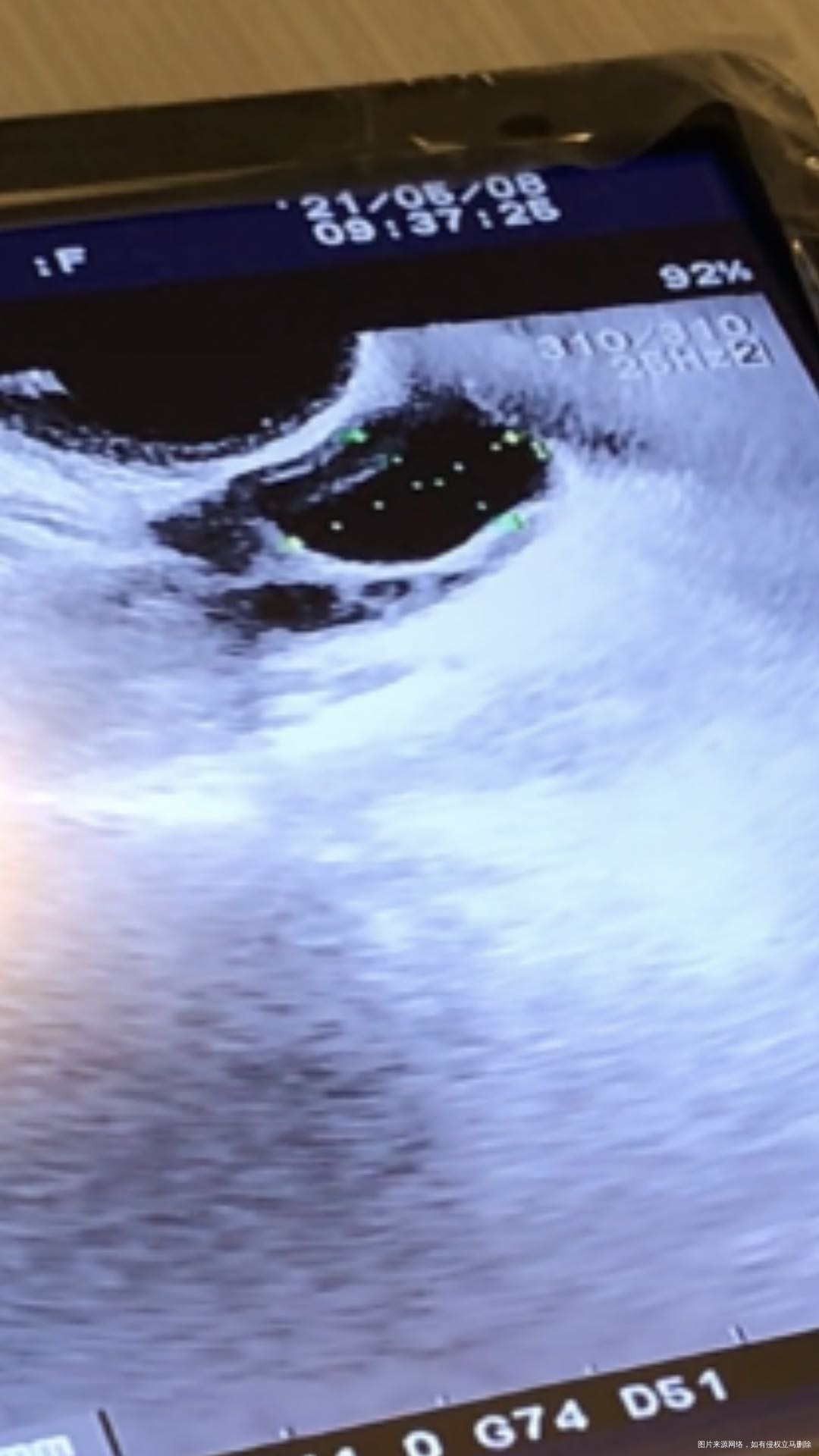 请医生帮忙看下b超图卵泡207乘以145内膜