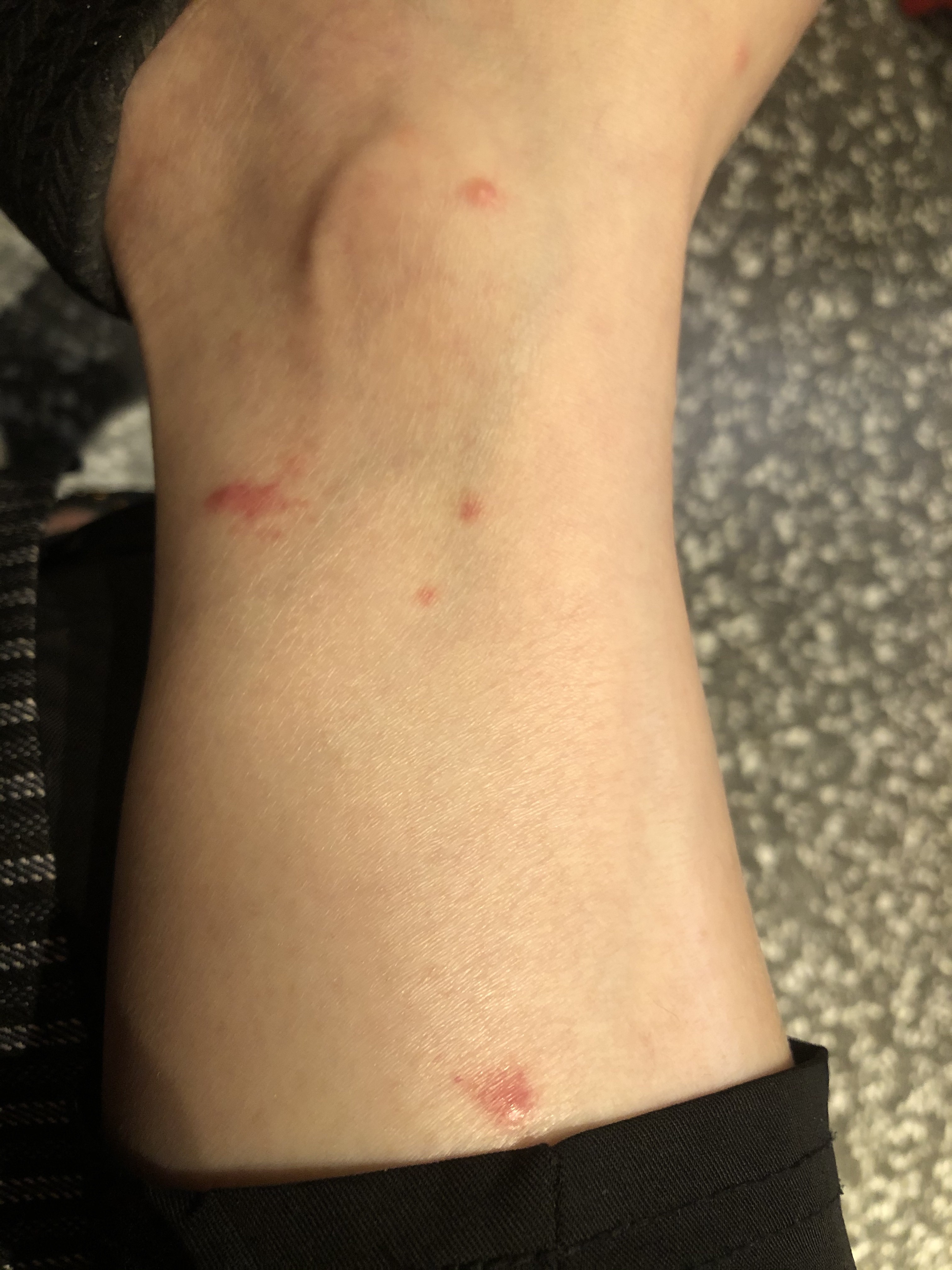 请问这些是什么也不是蚊子咬的每次早上睡醒起来