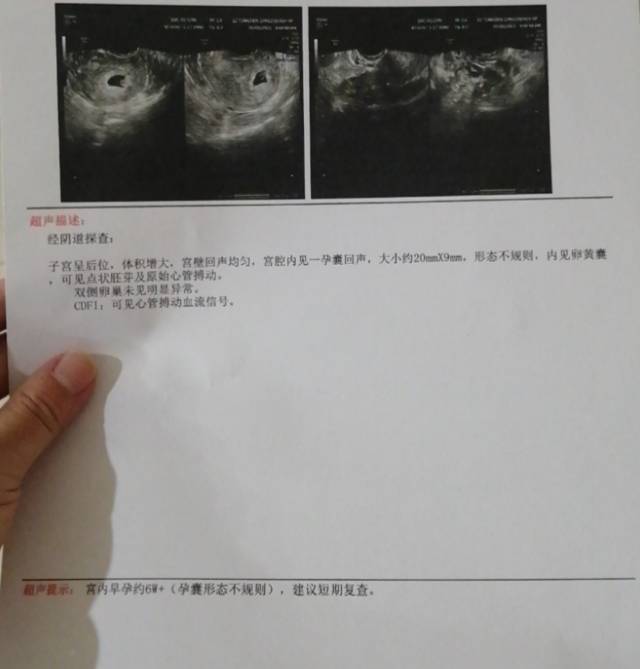 医生你好我今天去查早孕阴超显示我的孕囊大小2