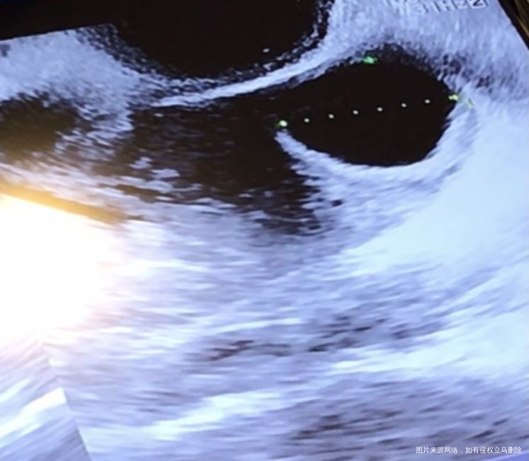 第一张图排卵前卵泡20毫米第二张图排卵后第六