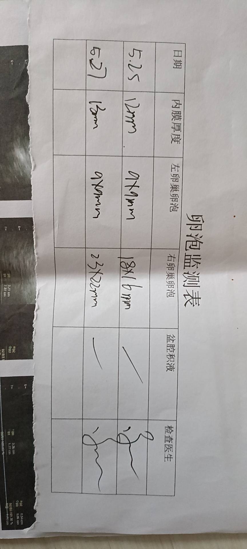 医生您好我每次都月经推迟大慨周期45天有一年